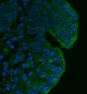 Immunofluorescent staining of FFPE human intestinal cancer tissue with CD55 antibody (green) and DAPI nuclear stain (blue). HIER: boil tissue sections in pH8 EDTA for 20 min and allow to cool before testing.