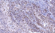 IHC staining of FFPE human laryngeal squamous cell carcinoma tissue with CDK2 antibody. HIER: boil tissue sections in pH8 EDTA for 20 min and allow to cool before testing.