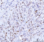 IHC staining of FFPE human breast cancer tissue with CDK2 antibody. HIER: boil tissue sections in pH8 EDTA for 20 min and allow to cool before testing.