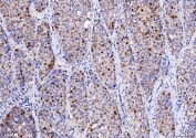 IHC staining of FFPE human liver cancer tissue with CDK2 antibody. HIER: boil tissue sections in pH8 EDTA for 20 min and allow to cool before testing.
