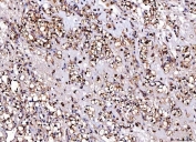 IHC staining of FFPE human renal clear cell carcinoma tissue with Cdc2 related protein kinase 2 antibody. HIER: boil tissue sections in pH8 EDTA for 20 min and allow to cool before testing.