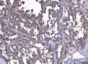 IHC staining of FFPE human serous adenocarcinoma of ovary tissue with Cdc2 related protein kinase 2 antibody. HIER: boil tissue sections in pH8 EDTA for 20 min and allow to cool before testing.