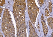 IHC staining of FFPE human liver cancer tissue with Cdc2 related protein kinase 2 antibody. HIER: boil tissue sections in pH8 EDTA for 20 min and allow to cool before testing.