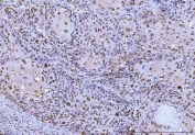 IHC staining of FFPE human laryngeal squamous cell carcinoma tissue with Cdc2 related protein kinase 2 antibody. HIER: boil tissue sections in pH8 EDTA for 20 min and allow to cool before testing.