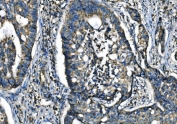 IHC staining of FFPE human adenocarcinoma of the right colon tissue with CMKBRL1 antibody. HIER: boil tissue sections in pH8 EDTA for 20 min and allow to cool before testing.