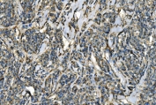 IHC staining of FFPE human lymphoma tissue with CMKBRL1 antibody. HIER: boil tissue sections in pH8 EDTA for 20 min and allow to cool before testing.