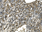 IHC staining of FFPE human liver cancer tissue with CMKBRL1 antibody. HIER: boil tissue sections in pH8 EDTA for 20 min and allow to cool before testing.