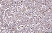 IHC staining of FFPE human melanoma tissue with DAB2 antibody. HIER: boil tissue sections in pH8 EDTA for 20 min and allow to cool before testing.