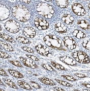 IHC staining of FFPE human rectal cancer tissue with MUC5B antibody. HIER: boil tissue sections in pH8 EDTA for 20 min and allow to cool before testing.