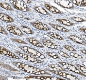 IHC staining of FFPE human rectal cancer tissue with MUC5B antibody. HIER: boil tissue sections in pH8 EDTA for 20 min and allow to cool before testing.