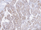 IHC staining of FFPE human liver cancer tissue with E2F transcription factor 3 antibody. HIER: boil tissue sections in pH8 EDTA for 20 min and allow to cool before testing.