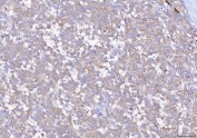 IHC staining of FFPE human melanoma tissue with Eukaryotic translation initiation factor 5A-1 antibody. HIER: boil tissue sections in pH8 EDTA for 20 min and allow to cool before testing.
