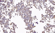 IHC staining of FFPE human lung cancer tissue with Uridylate-specific endoribonuclease antibody. HIER: boil tissue sections in pH8 EDTA for 20 min and allow to cool before testing.