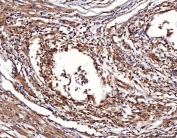 IHC staining of FFPE human cervical cancer tissue with ENO1 antibody. HIER: boil tissue sections in pH8 EDTA for 20 min and allow to cool before testing.