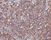 IHC staining of FFPE human lymphoma tissue with ENO1 antibody. HIER: boil tissue sections in pH8 EDTA for 20 min and allow to cool before testing.