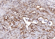 IHC staining of FFPE human gastric carcinoma tissue with ENO1 antibody. HIER: boil tissue sections in pH8 EDTA for 20 min and allow to cool before testing.