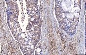 IHC staining of FFPE human adenocarcinoma of the right colon tissue with ENO1 antibody. HIER: boil tissue sections in pH8 EDTA for 20 min and allow to cool before testing.