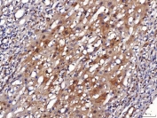 IHC staining of FFPE human liver cancer tissue with ENO1 antibody. HIER: boil tissue sections in pH8 EDTA for 20 min and allow to cool before testing.