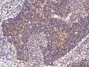 IHC staining of FFPE human lung cancer tissue with ENO1 antibody. HIER: boil tissue sections in pH8 EDTA for 20 min and allow to cool before testing.