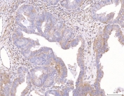 IHC staining of FFPE human endometrial cancer tissue with PC-1 antibody. HIER: boil tissue sections in pH8 EDTA for 20 min and allow to cool before testing.