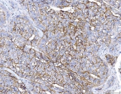IHC staining of FFPE human liver cancer tissue with PC-1 antibody. HIER: boil tissue sections in pH8 EDTA for 20 min and allow to cool before testing.