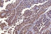 IHC staining of FFPE human bladder epithelial carcinoma tissue with Flap endonuclease 1 antibody. HIER: boil tissue sections in pH8 EDTA for 20 min and allow to cool before testing.