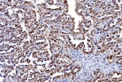 IHC staining of FFPE human ovarian cancer tissue with Flap endonuclease 1 antibody. HIER: boil tissue sections in pH8 EDTA for 20 min and allow to cool before testing.
