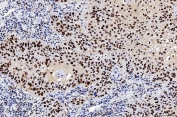 IHC staining of FFPE human laryngeal squamous cell carcinoma tissue with Flap endonuclease 1 antibody. HIER: boil tissue sections in pH8 EDTA for 20 min and allow to cool before testing.