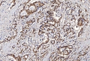 IHC staining of FFPE human colorectal adenocarcinoma tissue with Flap endonuclease 1 antibody. HIER: boil tissue sections in pH8 EDTA for 20 min and allow to cool before testing.