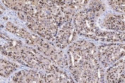 IHC staining of FFPE human liver cancer tissue with Flap endonuclease 1 antibody. HIER: boil tissue sections in pH8 EDTA for 20 min and allow to cool before testing.