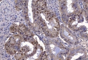 IHC staining of FFPE human endometrial cancer tissue with Flap endonuclease 1 antibody. HIER: boil tissue sections in pH8 EDTA for 20 min and allow to cool before testing.