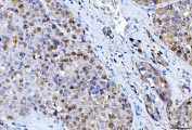 IHC staining of FFPE human liver cancer tissue with FEN1 antibody. HIER: boil tissue sections in pH8 EDTA for 20 min and allow to cool before testing.