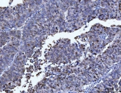 IHC staining of FFPE human ovarian cancer tissue with FEN1 antibody. HIER: boil tissue sections in pH8 EDTA for 20 min and allow to cool before testing.