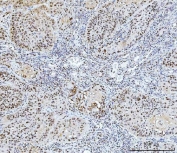 IHC staining of FFPE human laryngeal squamous cell carcinoma tissue with FEN1 antibody. HIER: boil tissue sections in pH8 EDTA for 20 min and allow to cool before testing.