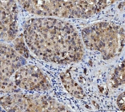 IHC staining of FFPE human liver cancer tissue with FEN1 antibody. HIER: boil tissue sections in pH8 EDTA for 20 min and allow to cool before testing.