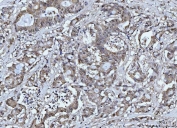 IHC staining of FFPE human colorectal adenocarcinoma tissue with FEN1 antibody. HIER: boil tissue sections in pH8 EDTA for 20 min and allow to cool before testing.