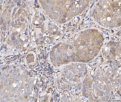 IHC staining of FFPE human liver cancer tissue with FIS1 antibody. HIER: boil tissue sections in pH8 EDTA for 20 min and allow to cool before testing.