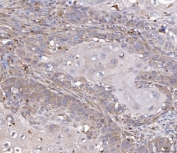 IHC staining of FFPE human laryngeal squamous cell carcinoma tissue with FIS1 antibody. HIER: boil tissue sections in pH8 EDTA for 20 min and allow to cool before testing.