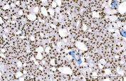 IHC staining of FFPE human renal cell carcinoma tissue with H1F0 antibody. HIER: boil tissue sections in pH8 EDTA for 20 min and allow to cool before testing.