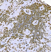 IHC staining of FFPE Hodgkin's lymphoma tissue with H1F0 antibody. HIER: boil tissue sections in pH8 EDTA for 20 min and allow to cool before testing.