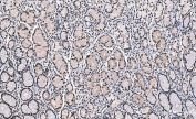 IHC staining of FFPE human gastric carcinoma tissue with H1F0 antibody. HIER: boil tissue sections in pH8 EDTA for 20 min and allow to cool before testing.