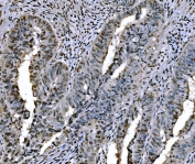IHC staining of FFPE human differentiated adenocarcinoma of the rectum tissue with H1F0 antibody. HIER: boil tissue sections in pH8 EDTA for 20 min and allow to cool before testing.