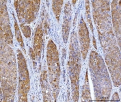IHC staining of FFPE human liver cancer tissue with Homogentisate 1,2-dioxygenase antibody. HIER: boil tissue sections in pH8 EDTA for 20 min and allow to cool before testing.