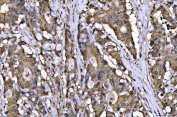 IHC staining of FFPE human colorectal adenocarcinoma tissue with AHSA1 antibody. HIER: boil tissue sections in pH8 EDTA for 20 min and allow to cool before testing.