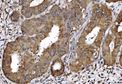 IHC staining of FFPE human endometrial cancer tissue with AHSA1 antibody. HIER: boil tissue sections in pH8 EDTA for 20 min and allow to cool before testing.