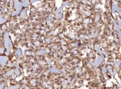 IHC staining of FFPE human breast infiltrating ductal carcinoma tissue with AHSA1 antibody. HIER: boil tissue sections in pH8 EDTA for 20 min and allow to cool before testing.