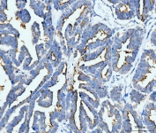 IHC staining of FFPE human ovarian serous adenocarcinoma tissue with Intercellular adhesion molecule 1 antibody. HIER: boil tissue sections in pH8 EDTA for 20 min and allow to cool before testing.
