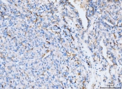 IHC staining of FFPE human renal carcinoma tissue with Intercellular adhesion molecule 1 antibody. HIER: boil tissue sections in pH8 EDTA for 20 min and allow to cool before testing.