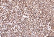 IHC staining of FFPE human lymphoma tissue with RAB5A/B/C antibody. HIER: boil tissue sections in pH8 EDTA for 20 min and allow to cool before testing.