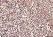 IHC staining of FFPE human lymphoma tissue with RAB5A/B/C antibody. HIER: boil tissue sections in pH8 EDTA for 20 min and allow to cool before testing.